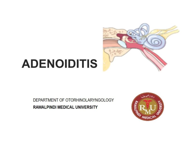 Adenoiditis.pptx