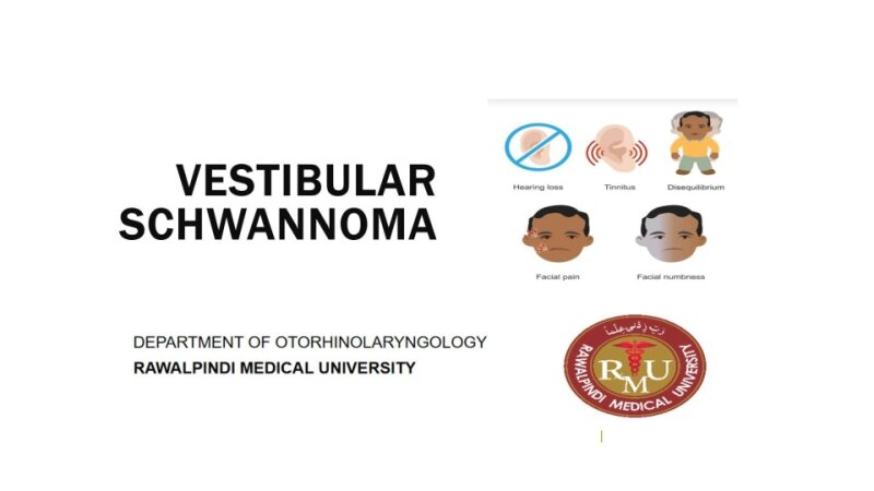Vestibular-schwanoma.pptx