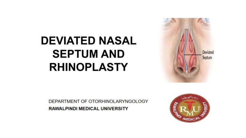 DNS-Rhinoplasty.pptx