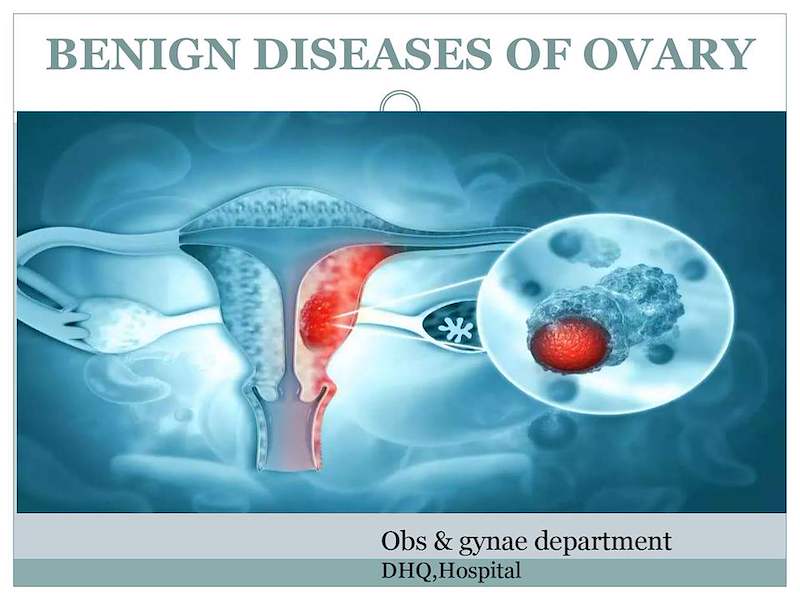 Benign and malignant ovarian tumours final with pretest (1).pdf