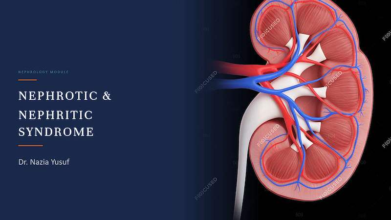 Nephrotic & Nephritic Syndrome by Dr Nazia.pptx