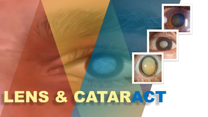 cataract-1-1.pptx