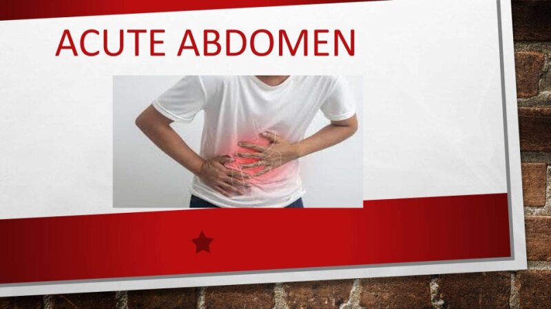 Acute Abdomen.ppt