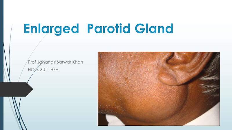 enlarged parotid swelling dr jsk (1)(2).pptx