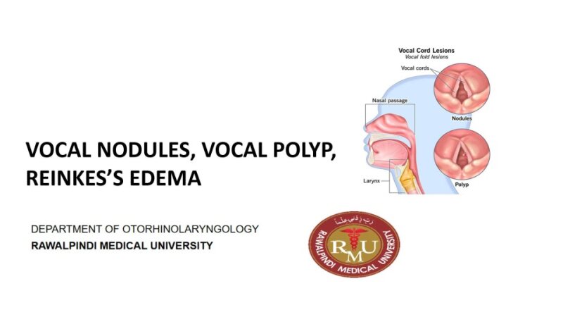 Vocal-NoduleVocal-polypReinkes-Edema.pptx