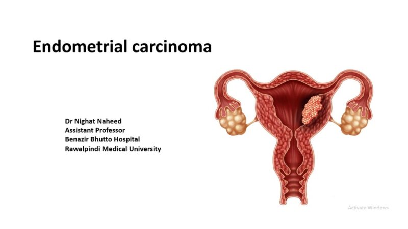 Final-CA-Endometrium-final-year-lecture.pptx