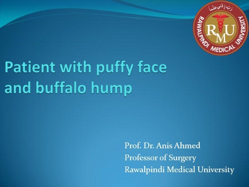 Patient with puffy face and buffalo hump Prof. Anis Ahmed.pdf