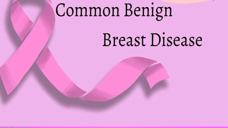 Benign-Breast-Diseases-lecture-asifa.pptx